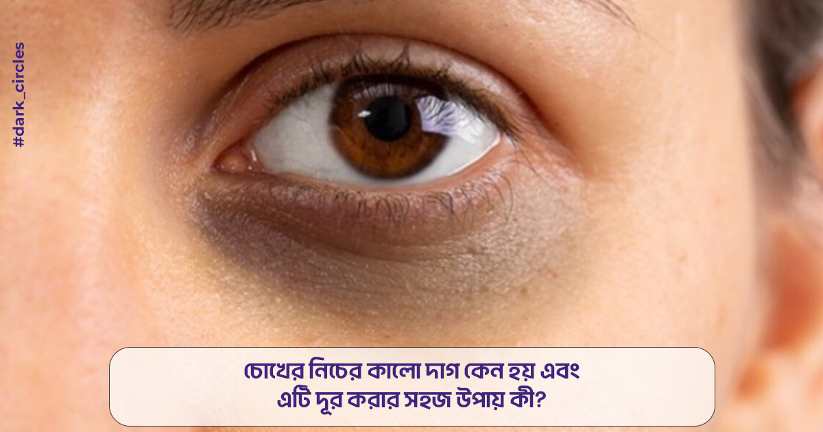 চোখের নিচের কালো দাগ কেন হয় এবং এটি দূর করার সহজ উপায় কী? 
