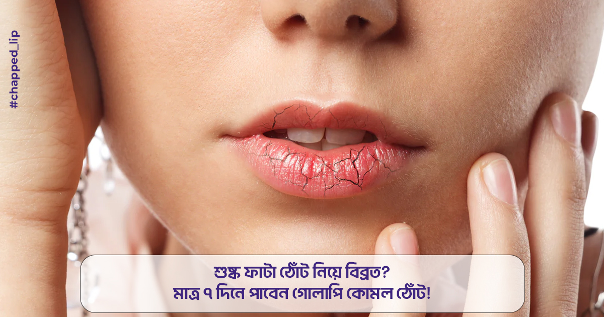 শুষ্ক ফাটা ঠোঁট নিয়ে বিব্রত? মাত্র ৭ দিনে পাবেন গোলাপি কোমল ঠোঁট! 