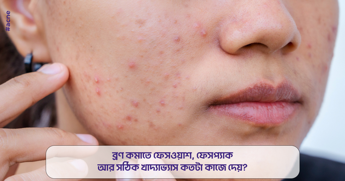 ব্রণ কমাতে ফেসওয়াশ, ফেসপ্যাক আর সঠিক খাদ্যাভ্যাস কতটা কাজে দেয়?
